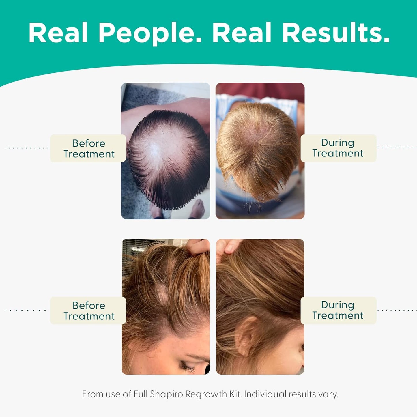 Shapiro MD Hair Growth Experts Hair Loss Leave-In Daily Foam, DHT Fighting Vegan Formula for Thinning Hair Developed by Dermatologists, Experience Healthier, Fuller, 2 Month Supply