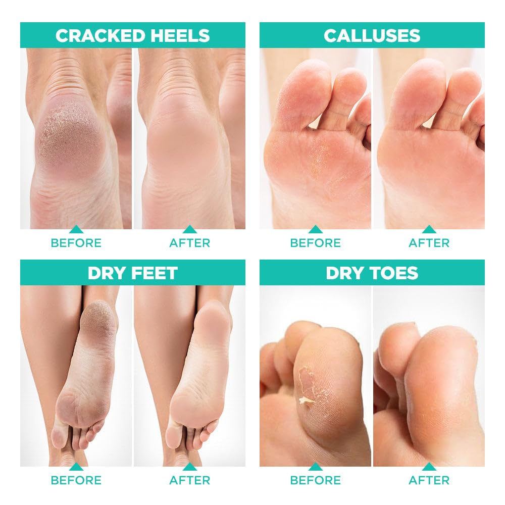 Lavinso Foot Peel Mask for Dry Cracked Feet – 3 Pack Peeling Mask Removes Dead Skin and Calluses - Exfoliating for Soft Baby Feet, Original Scent