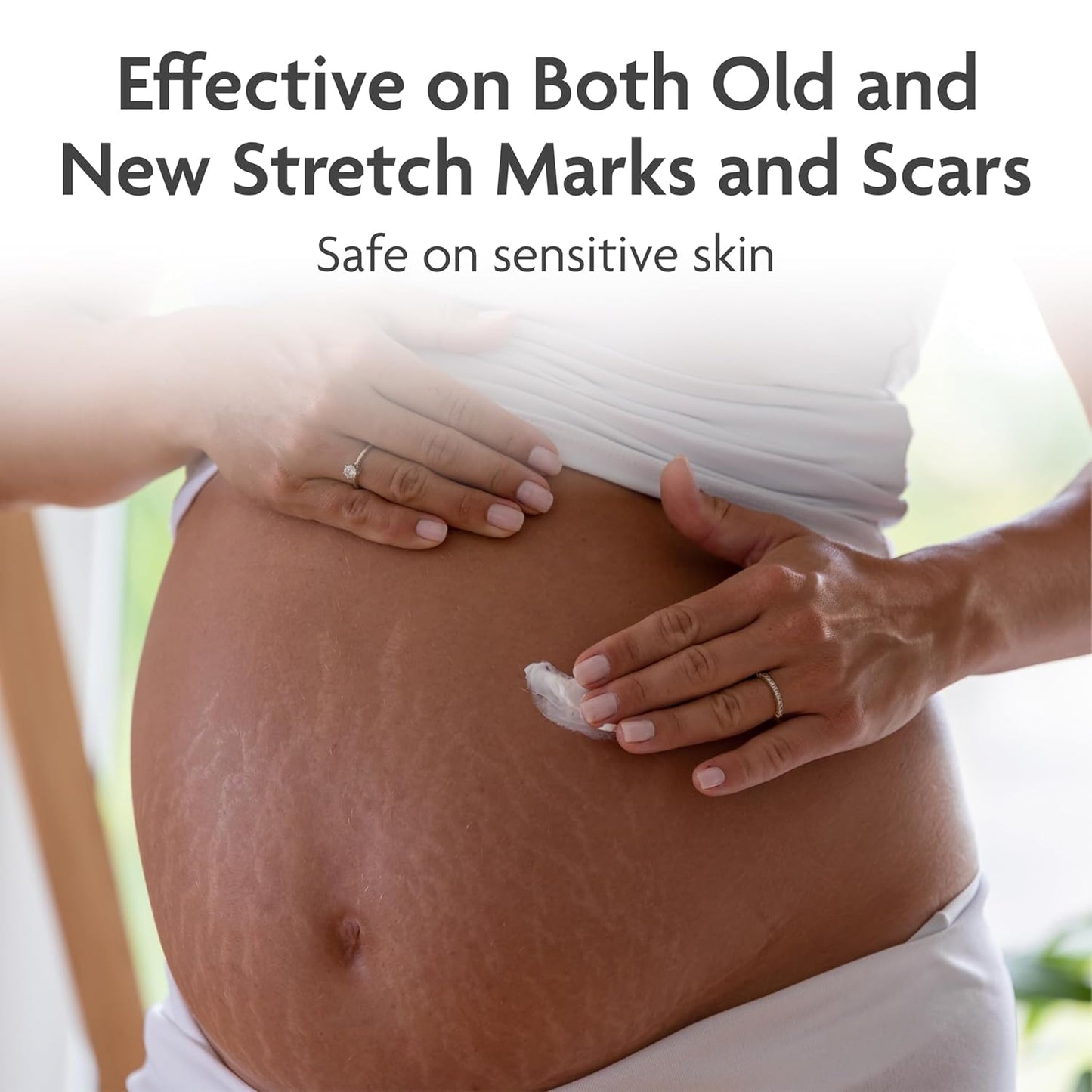 TriLASTIN-SR Intensive Stretch Mark Cream (5.5 oz.) for Pregnancy, Scar Cream and Moisturizing Lotion, Cocoa Butter, Scar Treatment, Hypoallergenic and Paraben-Free