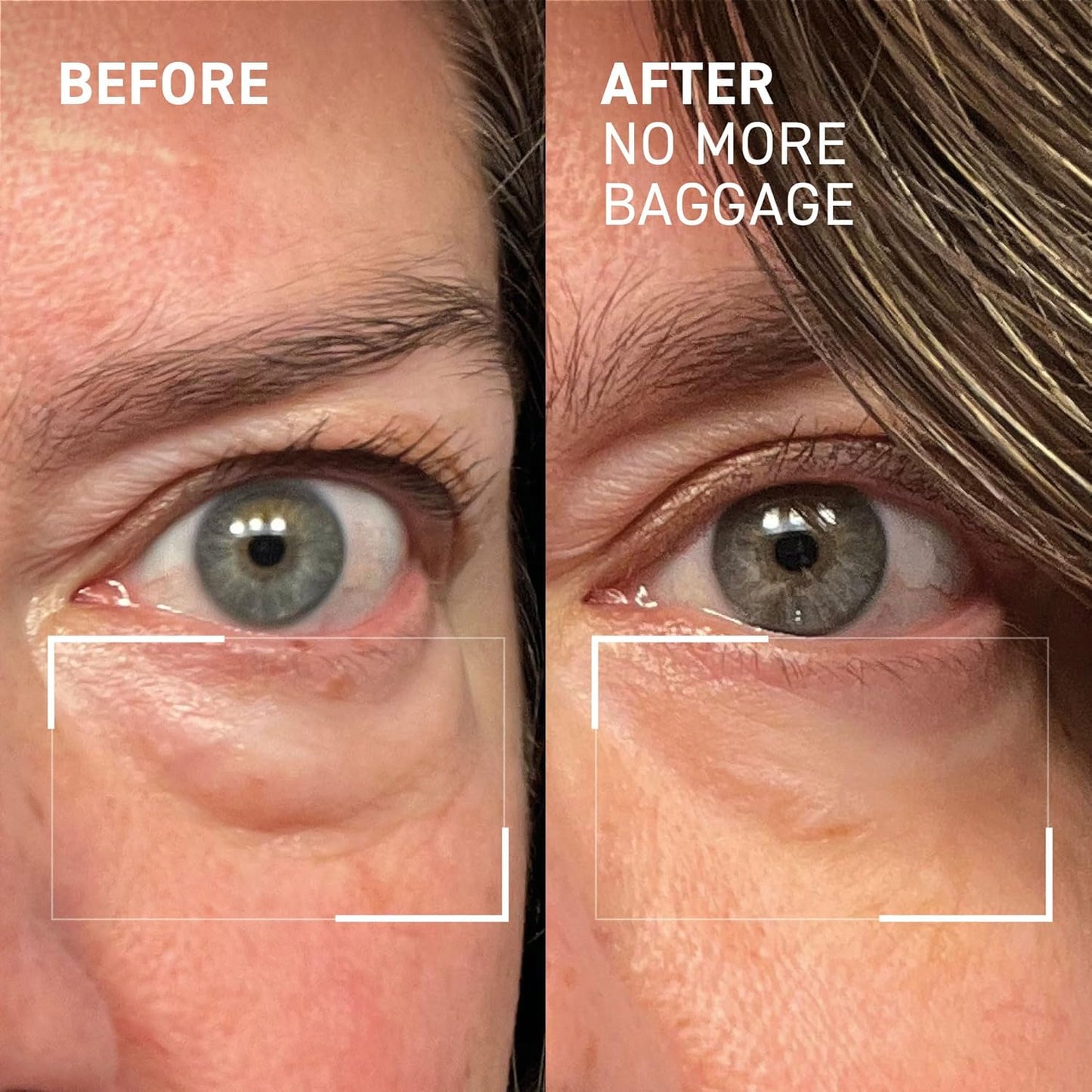 Dr. Brandt Needles No More Baggage - De-Puffs Under-Eye Bags and Brightens Dark Circles - Full (0.5 oz) + Travel Size (0.25 oz)