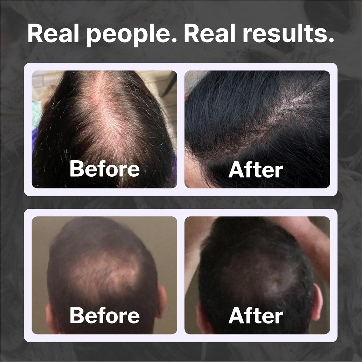 Shapiro MD Hair Growth Experts Natural Hair Kit for Thicker, Fuller, Healthier Looking Hair - Including Shampoo, Conditioner and Leave-In Daily Foam (4 Month)