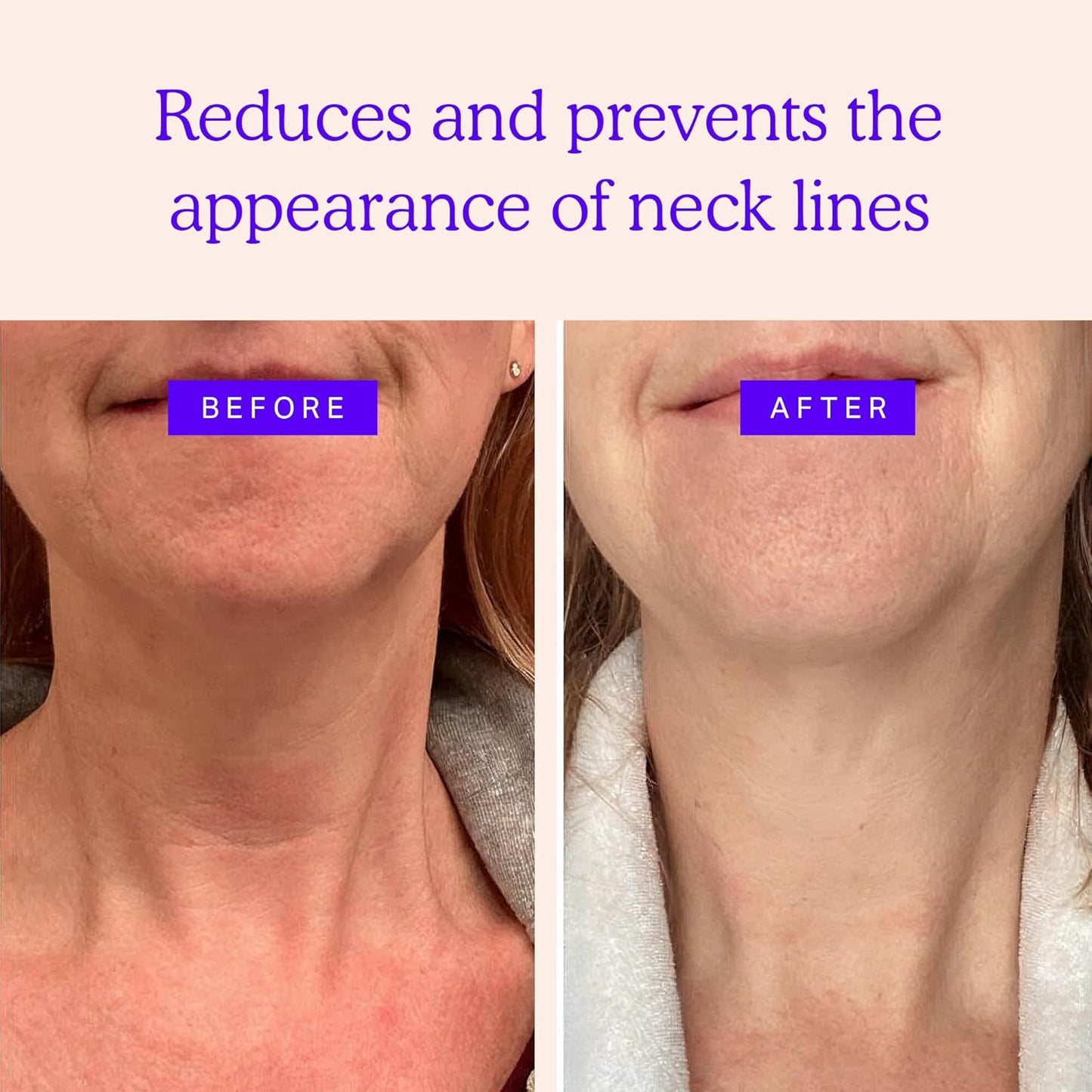 BLUMBODY Neck Wrinkle Patches – Anti-Wrinkle Silicone Patches for Skin Firming, Tightening – Reusable Overnight Pads – Anti-Aging Crepe Erase Pads – Neck, Décolleté (2-Month Supply)