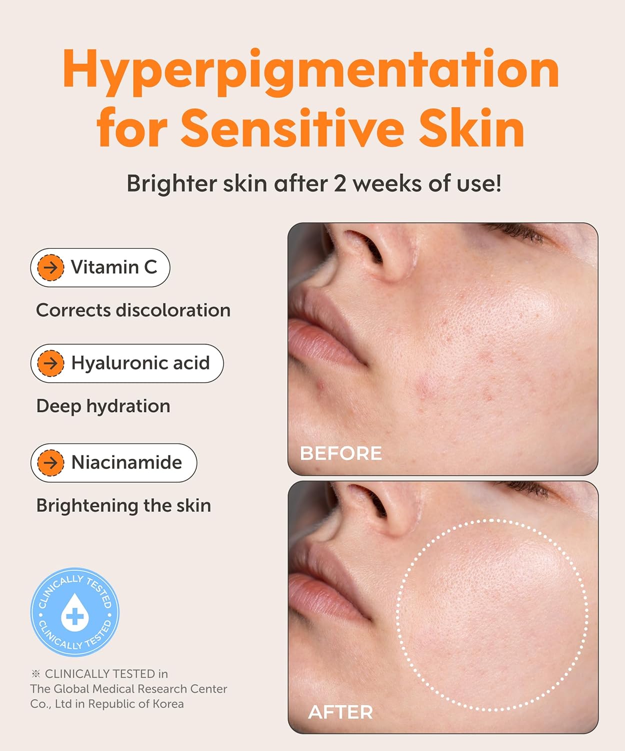 SERUMKIND Vitamin C Serum for Korean Face Skincare – Brightening for Dark Spots, Pore Refining, Discoloration Correcting – With Niacinamide – Reduces Fine Lines and Wrinkles